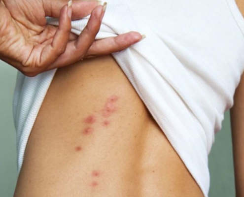 Image of bites on a woman's back