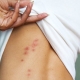Image of bites on a woman's back